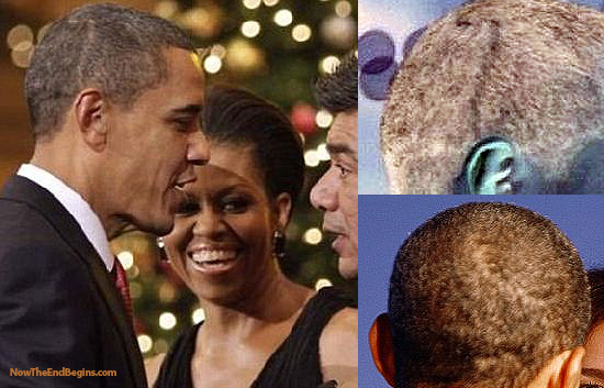 Obama's had brain surgery scars all the way around...